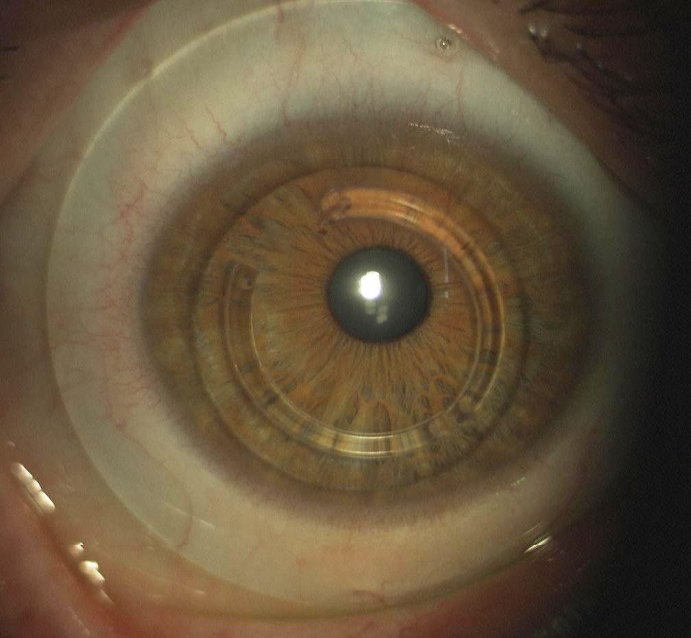 Kératocône anneau, lentille sclérale