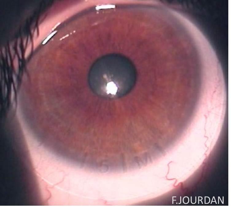 Lentille souple, astigmatisme