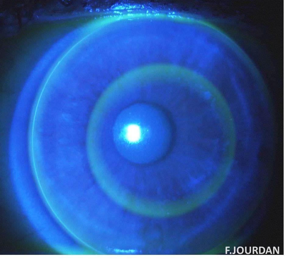 Lentille de nuit ortho-kératologie