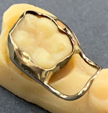 Un primer plano de un diente con un anillo de metal.