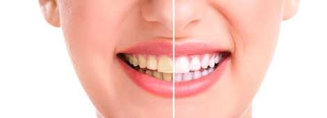 Primer plano de una boca sonriente dividida por una línea vertical, que muestra los dientes antes y después del blanqueamiento.