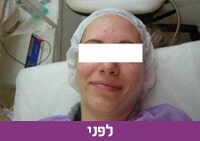 טיפולי אקנה - לפני