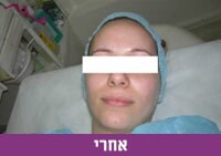 טיפולי אקנה - אחרי