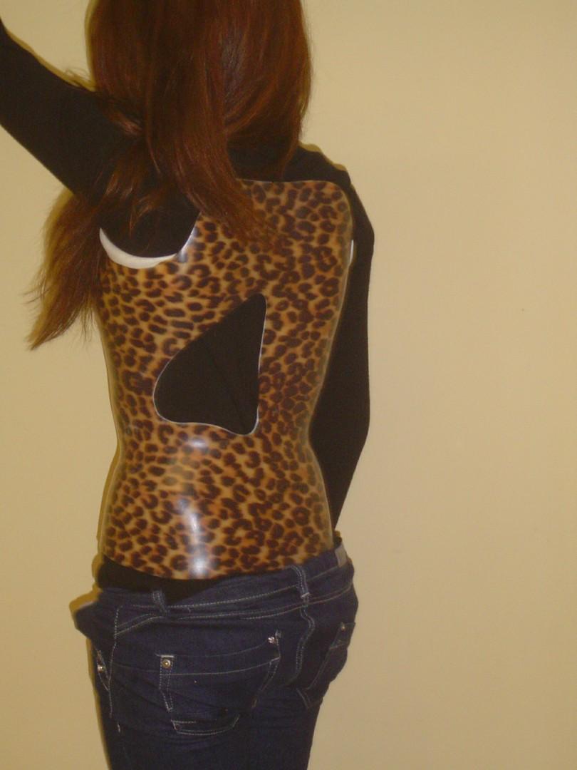 Orthèse en thermo-plastique personnalisée YVERNOGEAU CAEN