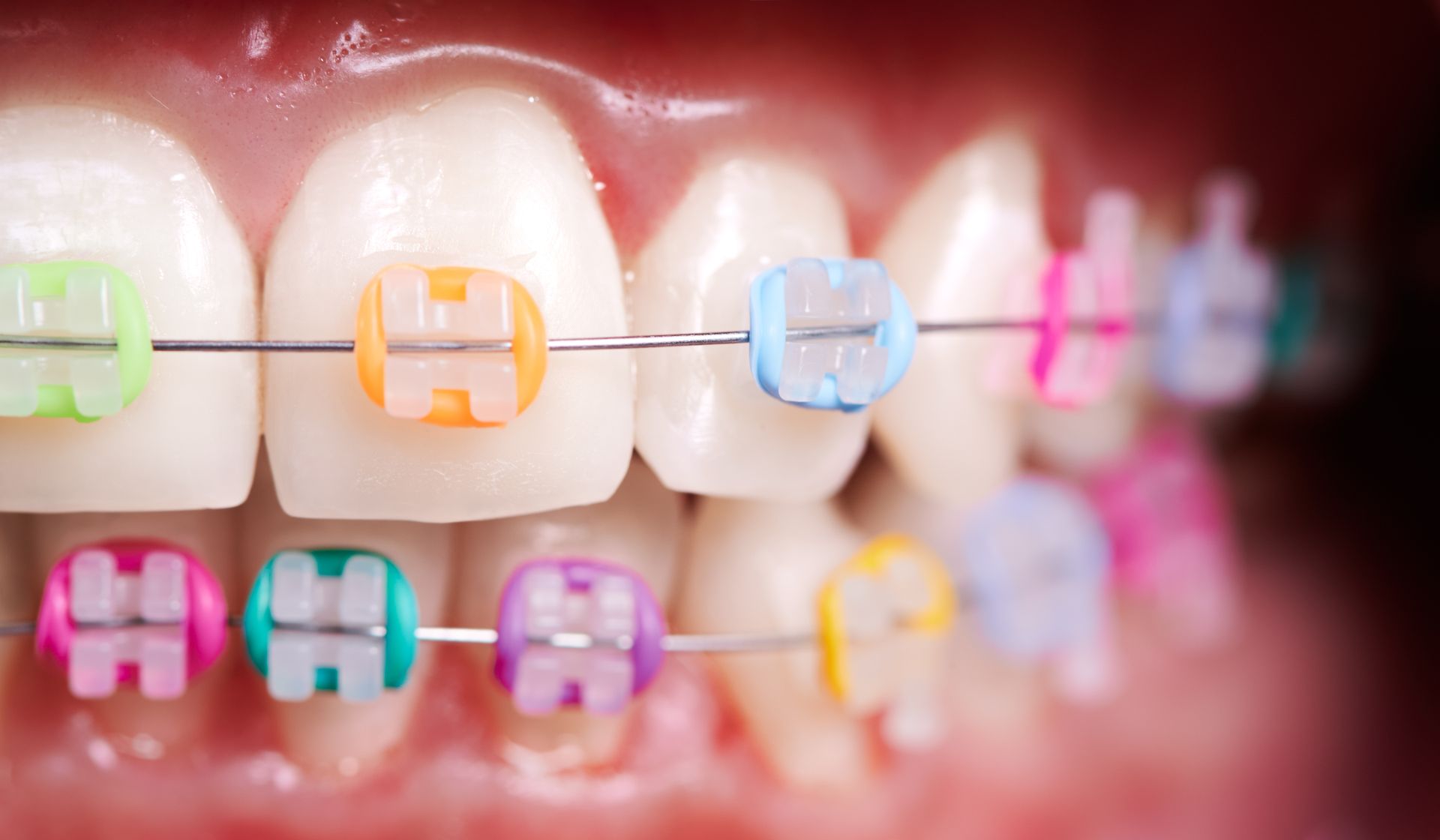 Soins d'orthodontie, bagues ou invisibles à Sartrouville