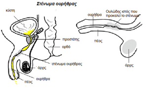 Διαστολή στενωμάτων ουρήθρας