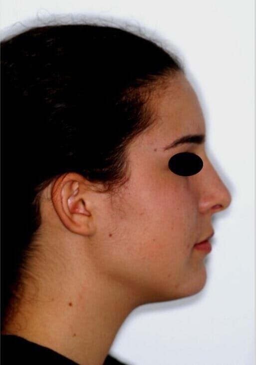 טיפול ללא עקירות אחרי