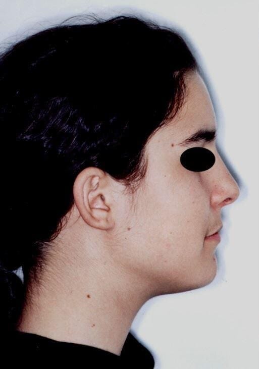 טיפול ללא עקירות לפני