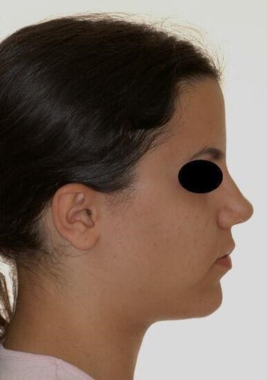 טיפול עם עקירות אחרי