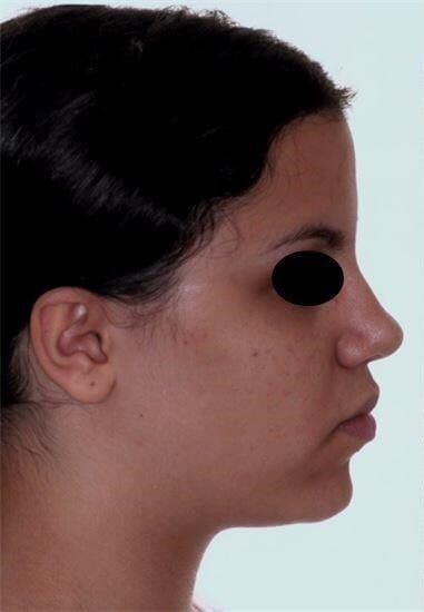 טיפול עם עקירות לפני