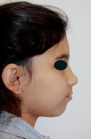 לסת עליונה קידמת ביחס ללסת התחתונה אחרי