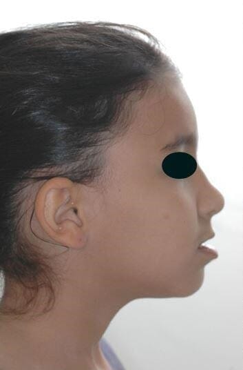 לסת עליונה קידמת ביחס ללסת התחתונה לפני