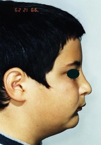 לסת עליונה קידמית ביחס ללסת תחתונה ,לפני