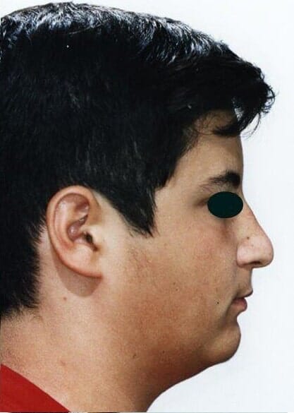 לסת עליונה קידמת ביחס ללסת התחתונה, אחרי