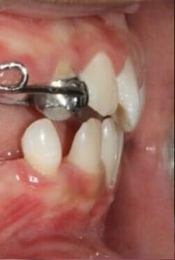 תמונות מתוך הפה, אחרי