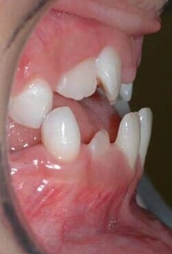 תמונות מתוך הפה, לפני