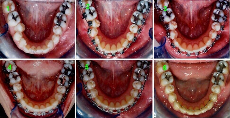 סידור קשתות השיניים