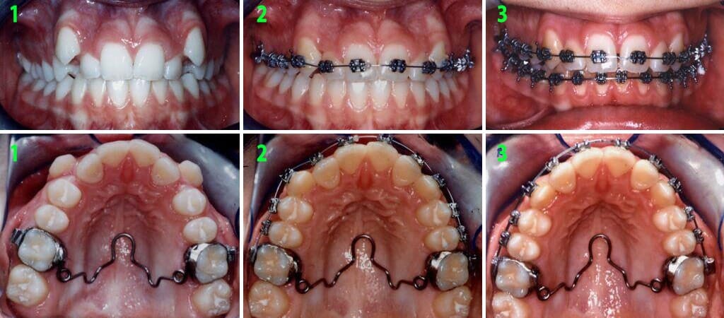 סידור קשתות השיניים