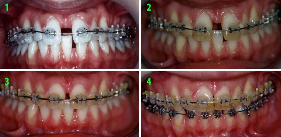 הזזת שיניים בטיפול אורתודונטי