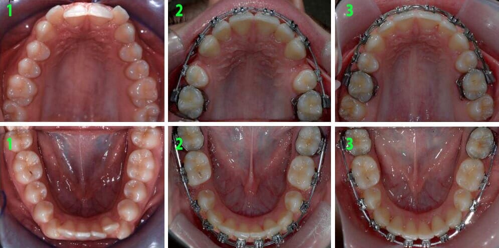 הזזת שיניים