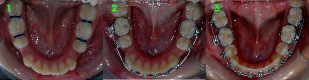 עקירות שיניים לצורך טיפול אורתודונטי