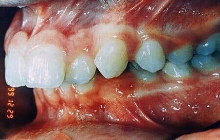 לפני טיפול שיניים                                    