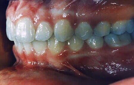 אחרי טיפול - סגר אידיאלי