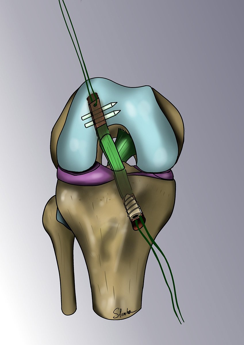 Chirurgie du Ligament Croisé dans notre médical à Paris — free download