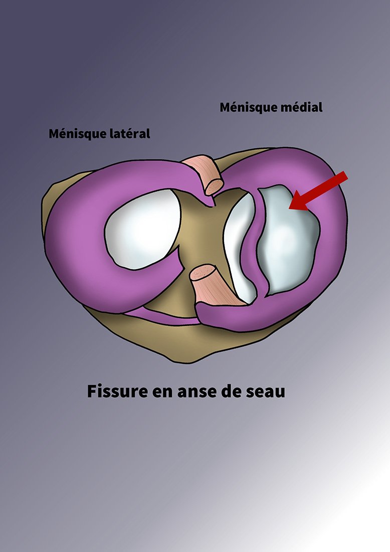 Pathologie Méniscale du Genou Clinique à Paris