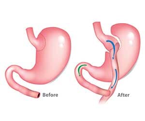 Γαστρικό "By-pass"