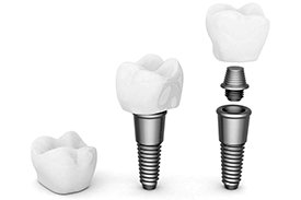 השתלות שיניים